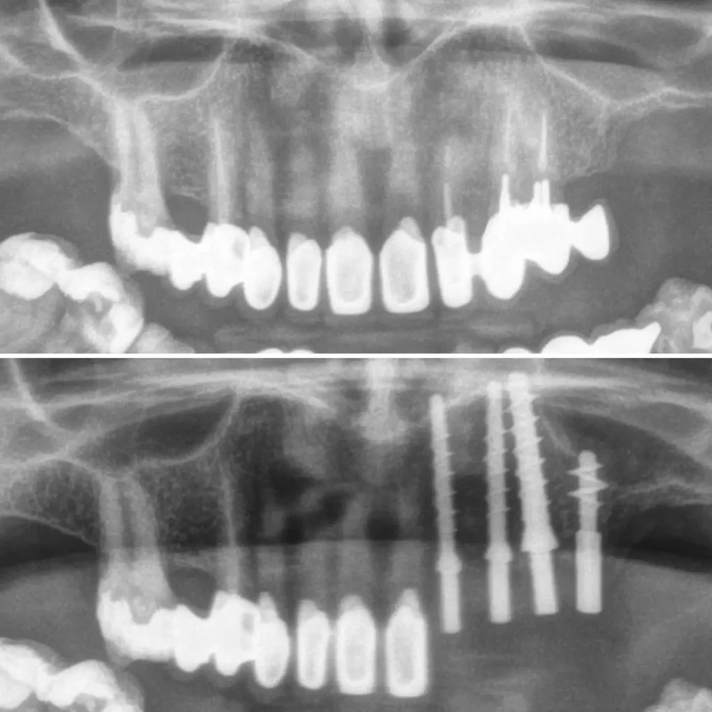 Implant jednofazowy tytanowy RTG