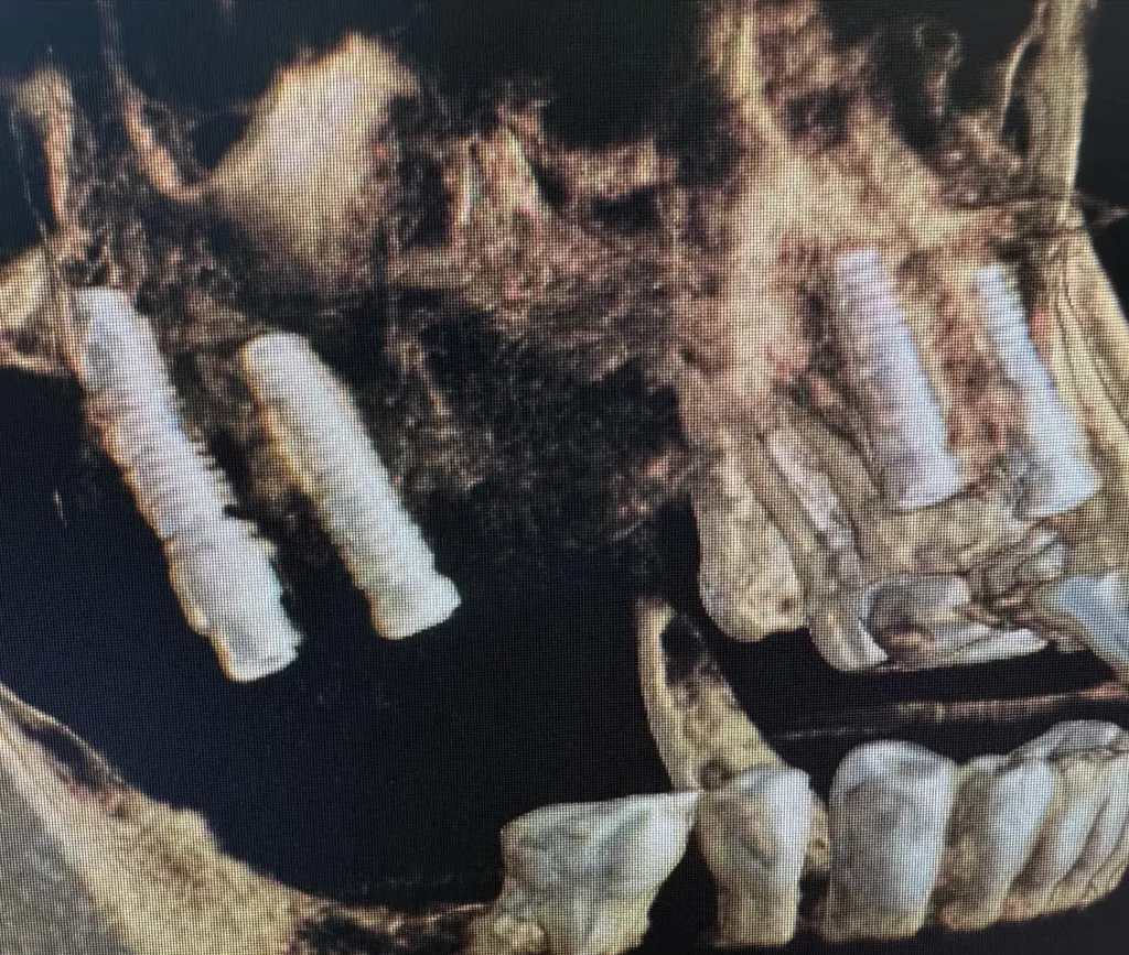 Implanty cyrkonowe - CBCT tomografia stożkowa